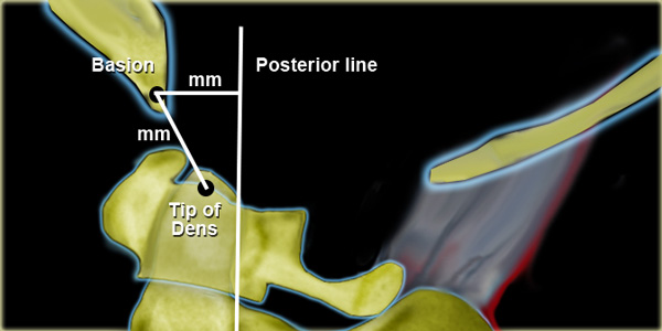 Harris' measurement for AO-DissociationRule of twelves= distance from tip of dens to basion or from basion to posterior line should not exceed 12 mm in an adult.