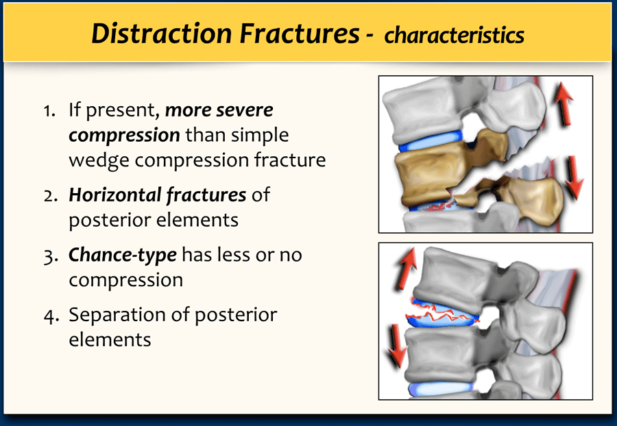 The Radiology Assistant : TLICS Classification of fractures