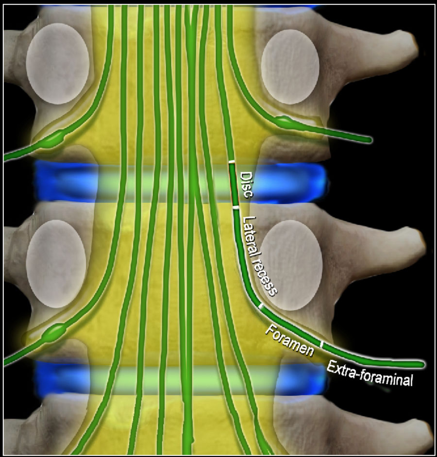 The Radiology Assistant : Spine - Lumbar Disc Herniation