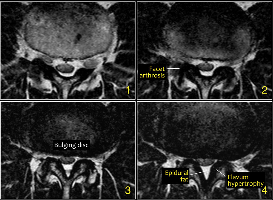 Ligamentum Flavum Thickening Mri / Extensive calcification of the