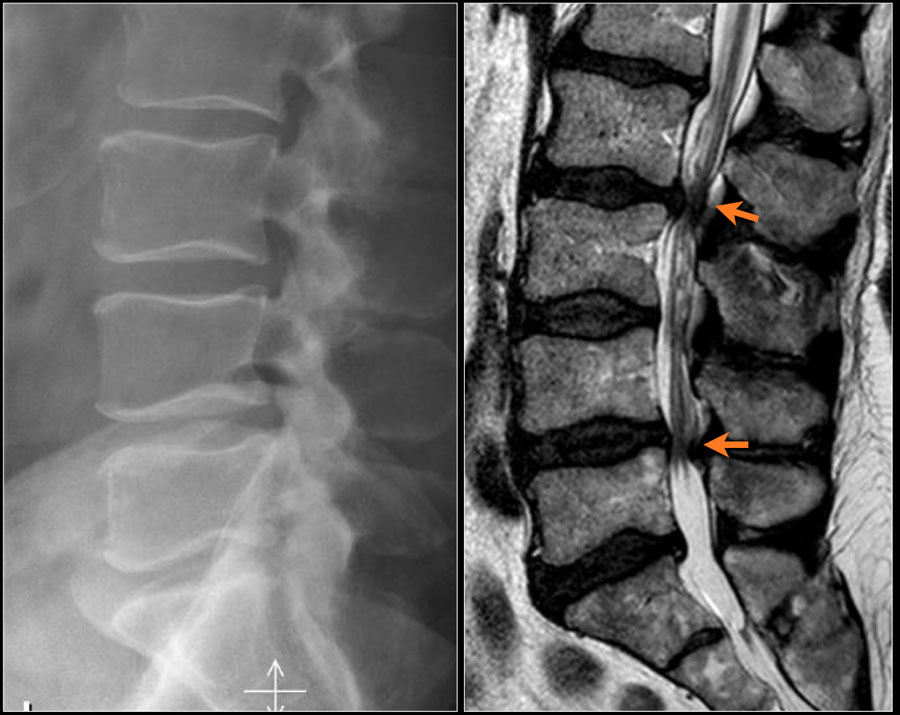 bulging disk on xray