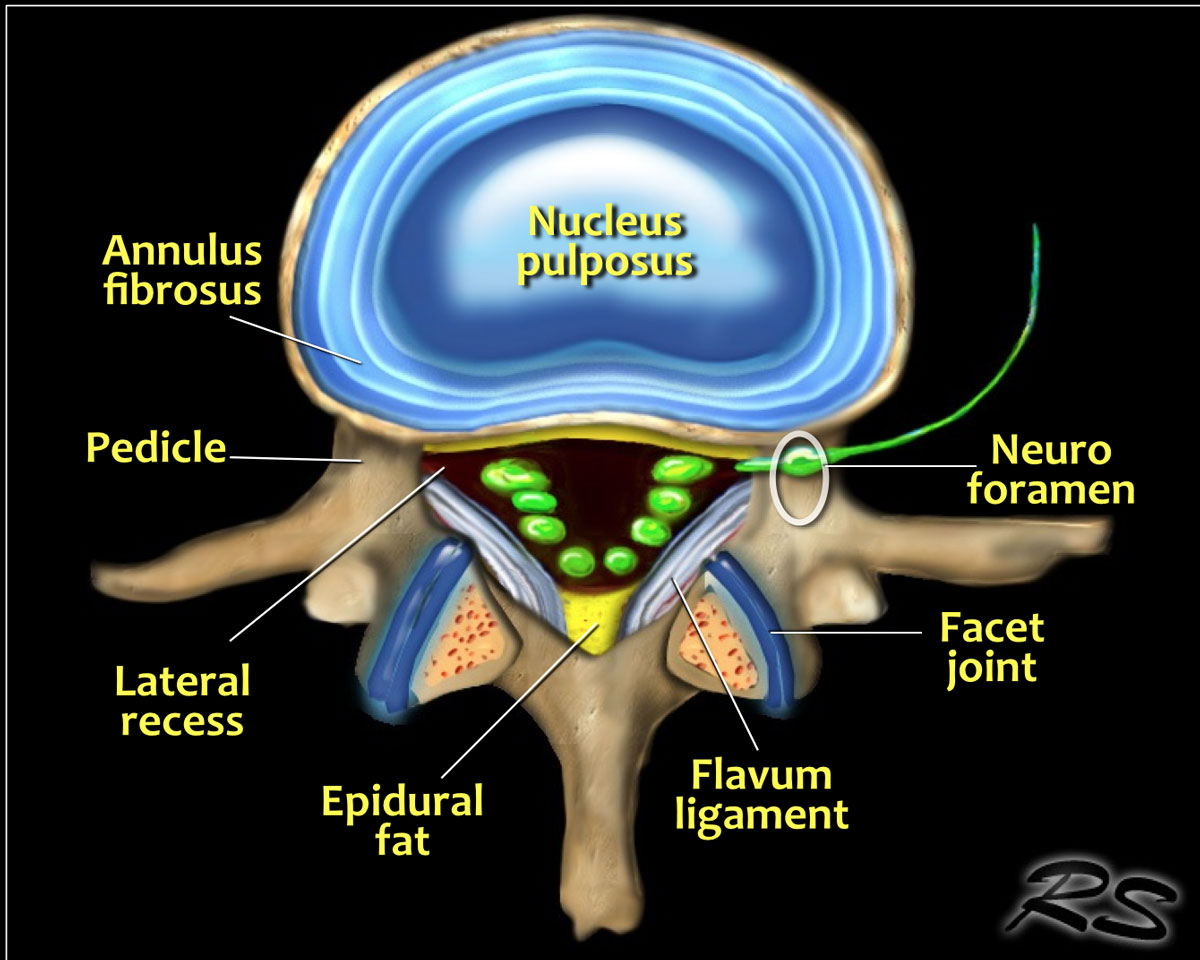 Herniated Disc Lumbar Spine Anatomy | Images and Photos finder
