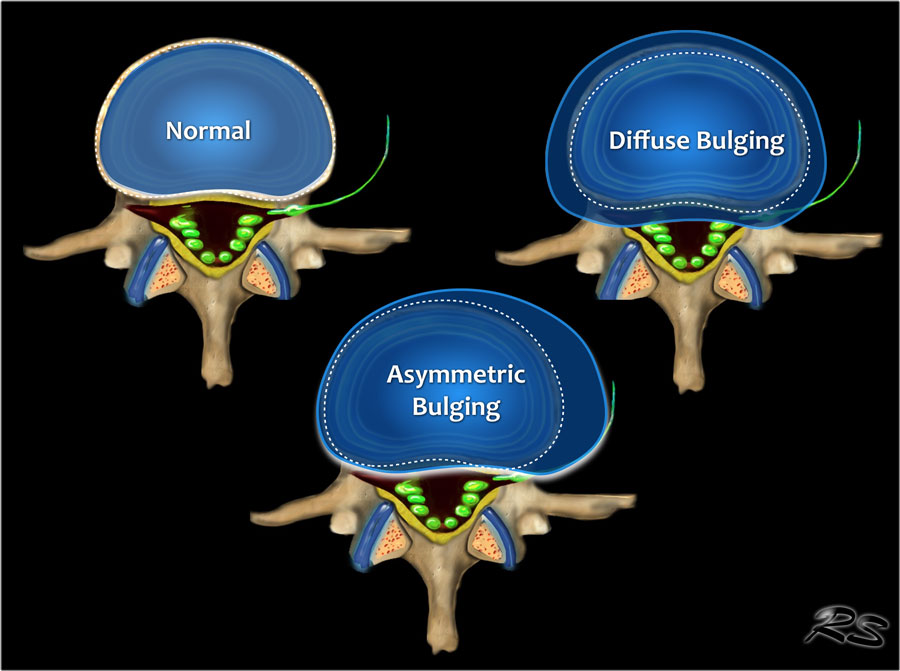 still-wondering-what-a-diffuse-disc-bulge-is-and-is-abutting-nerve-root