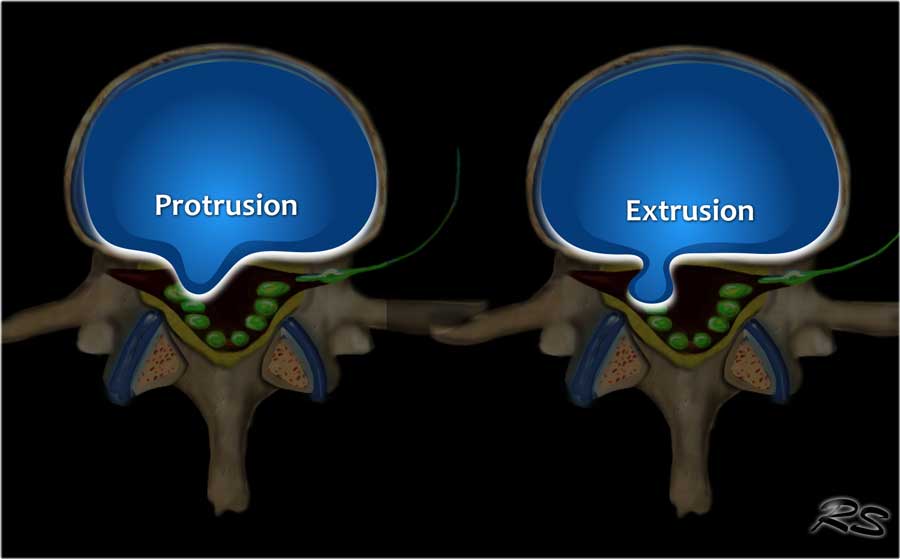 Disc Protrusion versus Extrusion