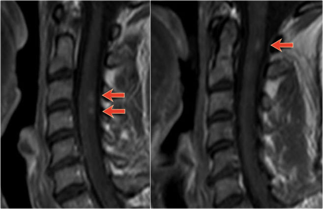 Acute exacerbation of cerebral and spinal MS
