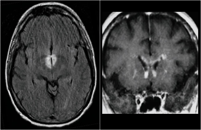 Periventricular lesions in NMO around third and lateral ventricles.