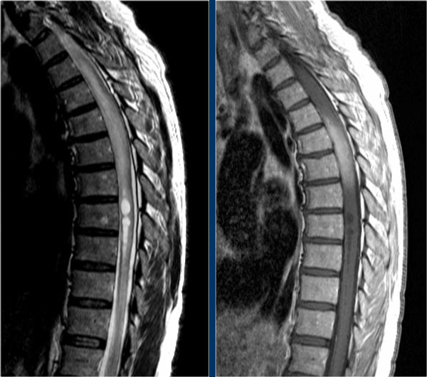 Spinal astrocytoma