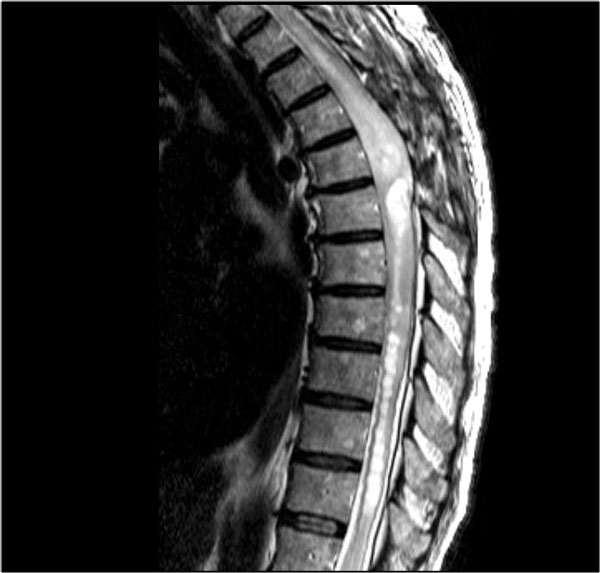 Spinal astrocytoma - follow up