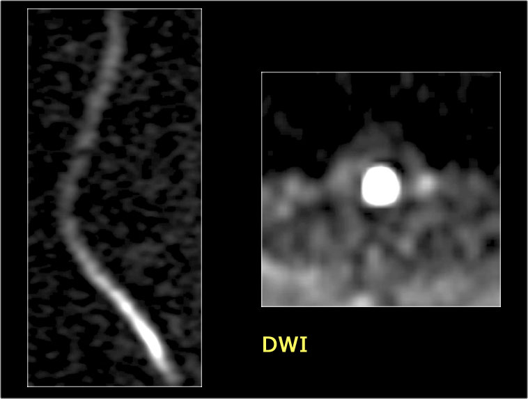 DWI in spinal chord ischemia