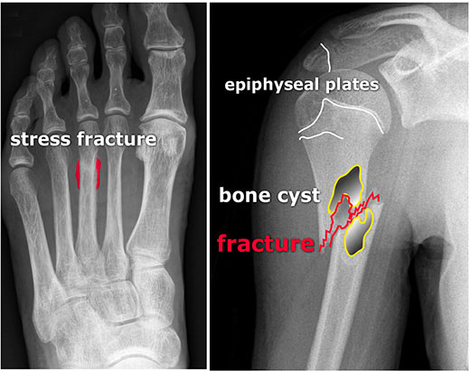 A (cloudy) periostal reaction around the mid shaft of metatarsal III, image of a stress fracture (a). Pathological humeral shaft fracture in a child with a bone cyst (b) Normal epiphyseal plates (= growth plates).