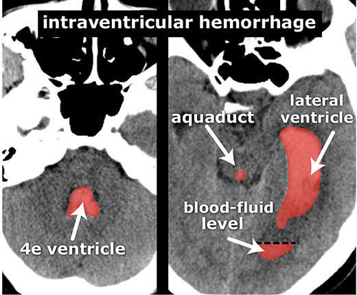 Extensive intraventricular blood in the left lateral ventricle, the aqueduct and the 4th ventricle.