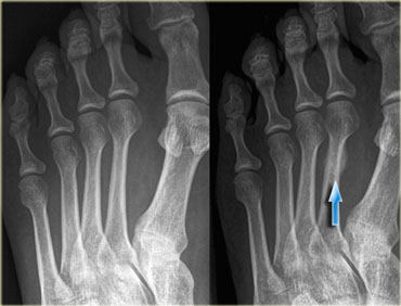 Typical stress fracture of the distal shaft of the second metatarsal not seen on initial radiograph (left). Callus formation is seen at 4 weeks follow up.