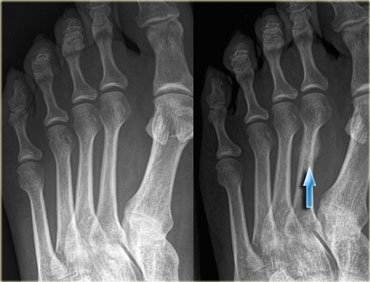 fractured toe xray