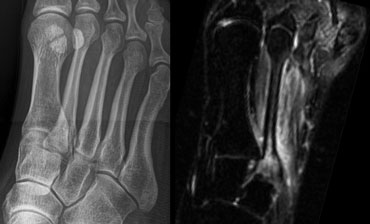 Stress fracture: Normal radiograph, while STIR image already shows a high signal intensity of the bone marrow