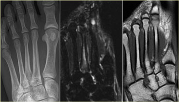 Radiograph, STIR and T1WI of grade 3 stress fracture of 3rd metatarsal.
