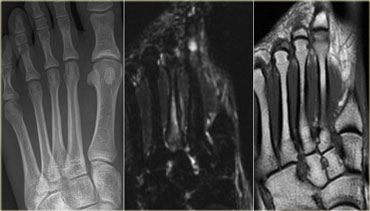 metatarsal stress fracture mri