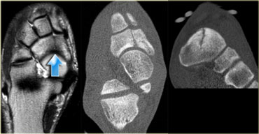Grade 4 stress fracture of the navicular bone. T1WI and CT (axial image and coronal reconstruction)