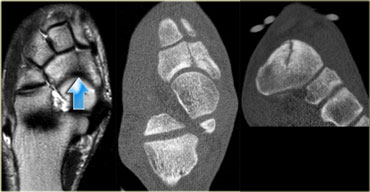 metatarsal stress fracture mri