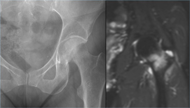 Stress fracture of the femoral neck located on the compression side.