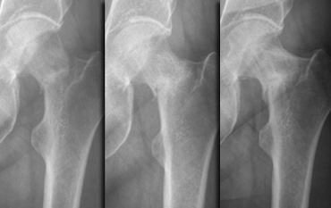 Follow-up radiographs at 1, 3 and 13 months