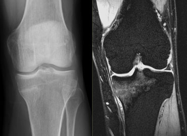 Stress fracture on the medial side of the proximal tibia in a 42-year old runner. Courtesy Dr Wuisman (3)