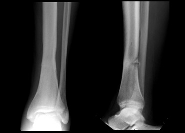 Stress fracture of the lower tibia.