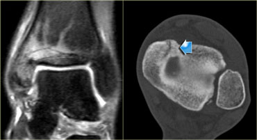 Medial malleolar stress fracture: Initial coronal STIR image and CT at 11 months follow-up.