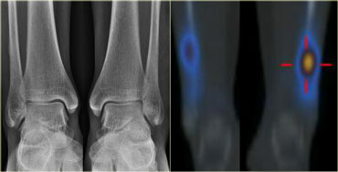 Bilateral stress fracture of the distal fibula: Initial radiographs and Bone scintigraphy at 2 weeks follow up.