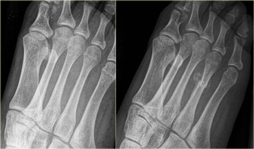 Stress fracture of 4th metatarsal: Radiograph at presentation and at 3 weeks follow up.