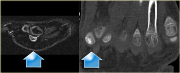 Stress fracture of sesamoid of great toe: sagittal STIR and axial CT.