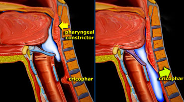 LEFT: Pharyngeal constrictors push the bolus down. RIGHT: Together with the contraction of the inferior constrictor, the cricopharyngeus relaxes.