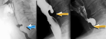 LEFT: small pouch. MIDDLE and RIGHT: true Zenker's diverticulum due to premature closure of the cricopharyngeus (yellow arrow)