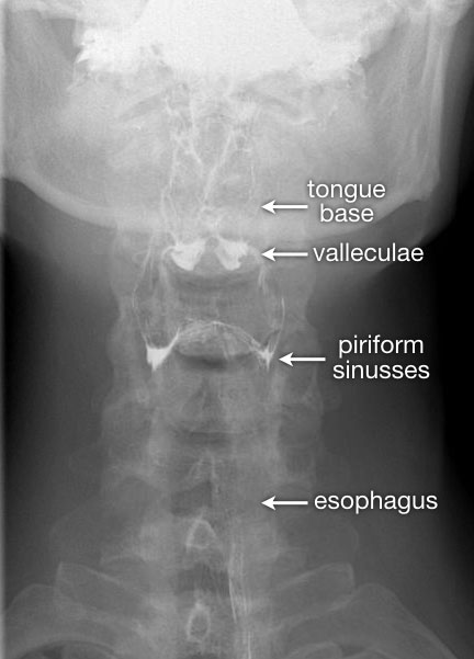 The Radiology Assistant : Swallowing disorders update