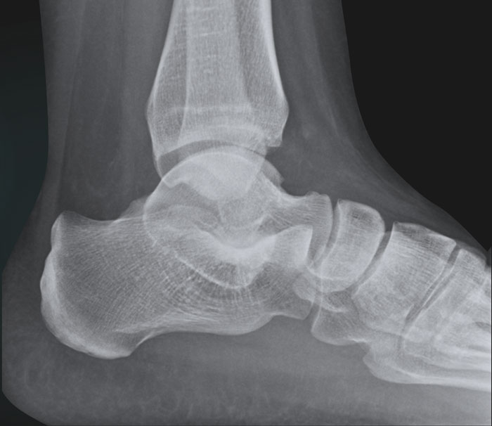 Normal foot x-ray - 2-year-old, Radiology Case