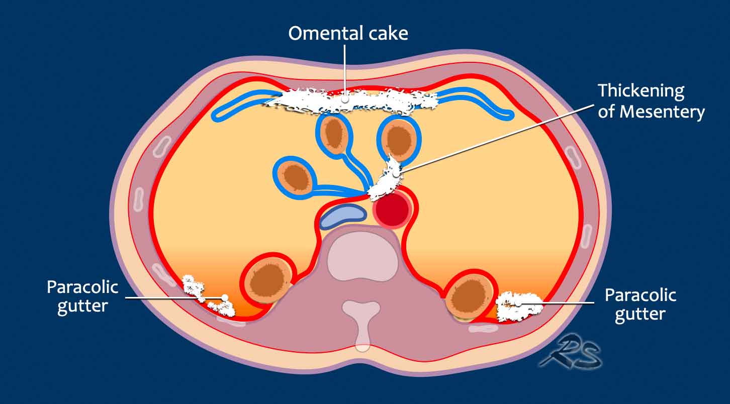 The Radiology Assistant : Peritoneal Carcinomatosis