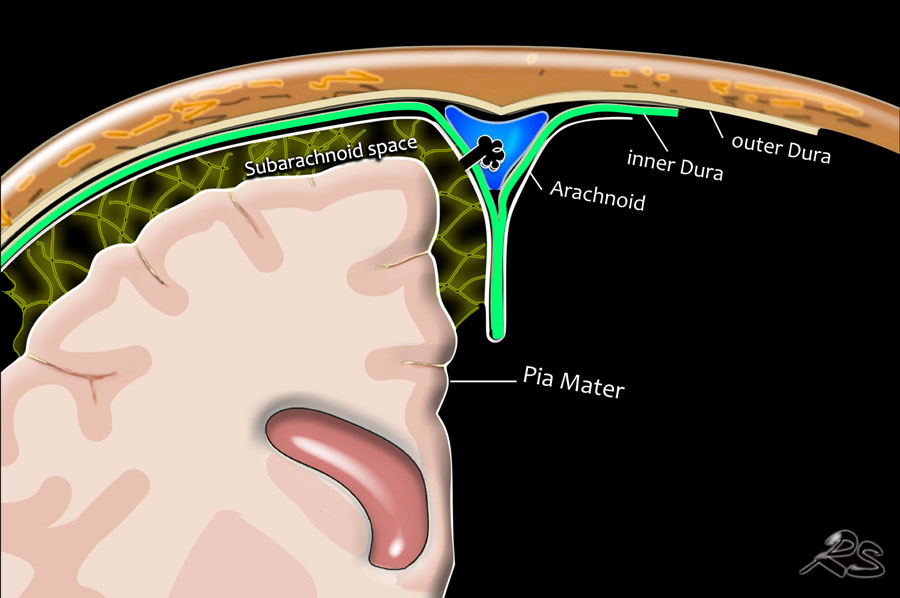 The Radiology Assistant : Traumatic Intracranial Hemorrhage