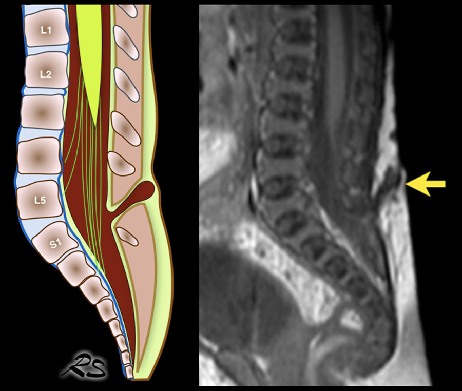 Spina Bifida Mri 8112