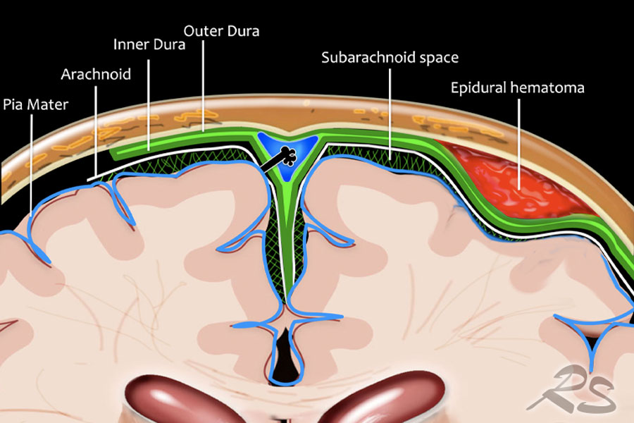 Hemorrhage vs intracranial subdural hematoma Subarachnoid and