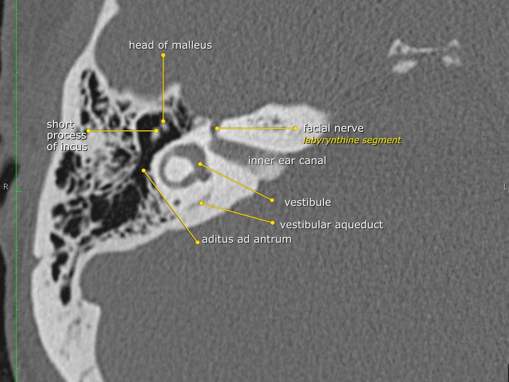 The Radiology Assistant : Temporal bone - Anatomy 2.0
