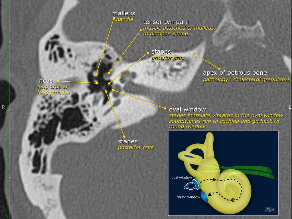 The Radiology Assistant : Temporal bone - Anatomy 2.0