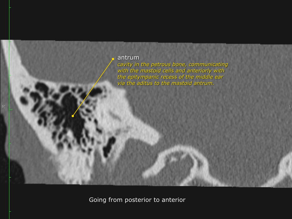 Temporal Bone Ct Anatomy - Anatomical Charts & Posters