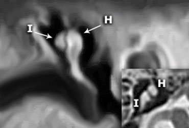 Coronal reconstruction clearly demonstates that the incus (I) is positioned posterolateral to the malleolar head (H).On the axial image the short crus of the incus is seen pointing posterolaterally.