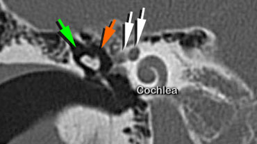 Head of malleus (orange arrow) is seen medial to the Incus (green arrow)