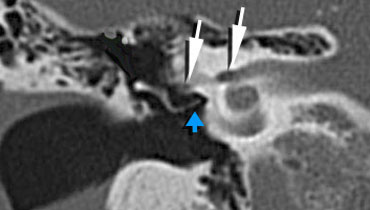 Long crus of the incus is seen connecting to the Stapes (blue arrow).Facial nerve in internal auditory canal and tympanic segment (white arrows).