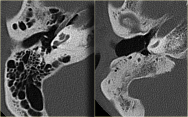 Normal pneumatization (left) and a completely sclerotic mastoid (right)
