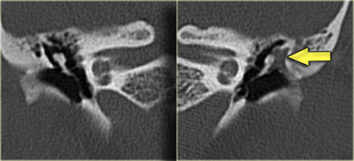 20-year old woman with recurrent otitis. Granulations on left ear drum. Soft tissue mass between ossicular chain and lateral tympanic wall,  which is eroded. Right side for comparison.