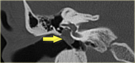 Cholesteatoma with lateral displacement of the incus with erosion of its lenticular process and of the stapes