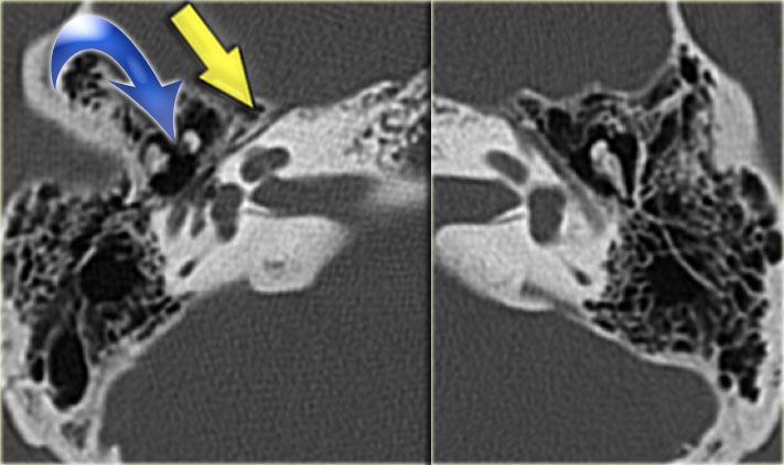 Longitudinal fracture (yellow arrow) coursing through the mastoid towards the region of the geniculate ganglion. Dislocation of the incus with luxation of the incudo-mallear and incudo-stapedial joint (blue arrow).