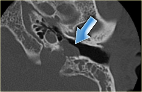 Glomus tumor in the  jugular foramen