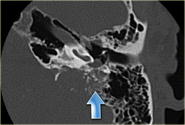 EndoLymphatic Sac Tumor: destructive process of the dorsal temporal bone, with some calcification (arrow). The location, destruction, and calcification are typical for ELST. A small extension of the tumor into the middle ear is present